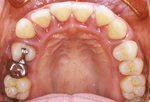 歯周病２
