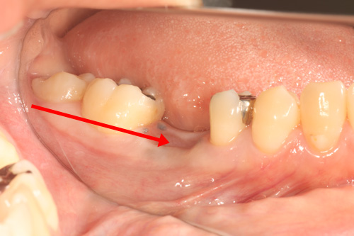 歯牙移植１ 治療前