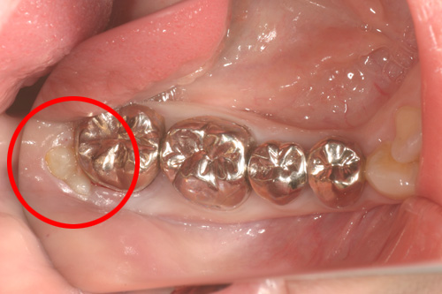 歯牙移植２　施術前