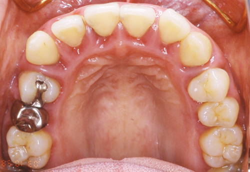 歯周病３ 治療前