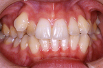 矯正３ 八重歯の矯正治療